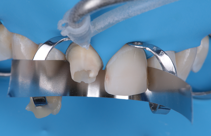 Solventum-BeitragVeneers-17444 Composite sandblast build-up-850x550