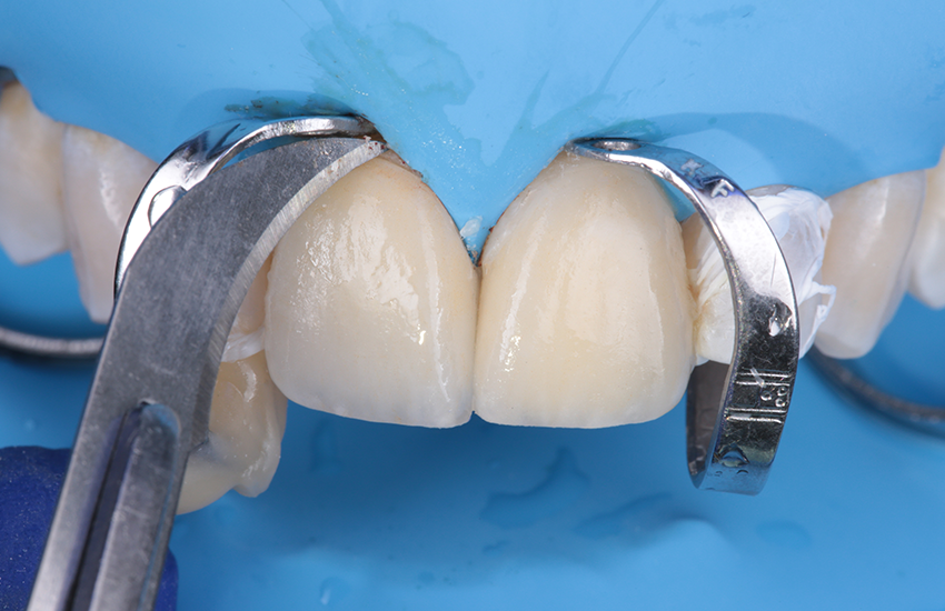 Solventum-BeitragVeneers-17444 Excess clean up-850x550