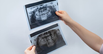 Zwei dentale Röntgenaufnahmen im Vergleich