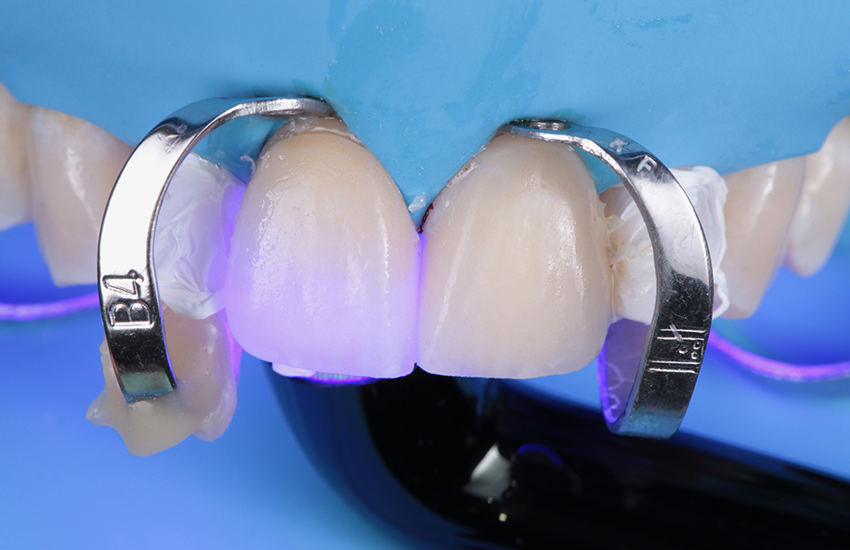 Solventum-BeitragVeneers-17444 Light curing-850x550
