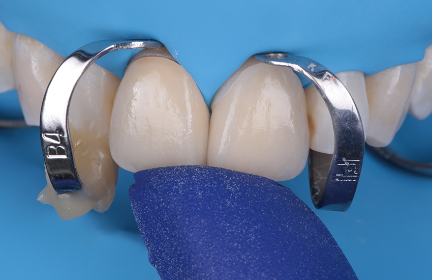 Solventum-BeitragVeneers-
 17444 Final Try-in-850x550