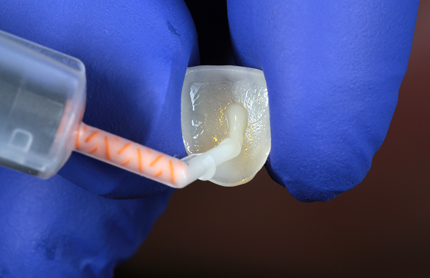 Solventum-BeitragVeneers-17444 RelyX application-850x550