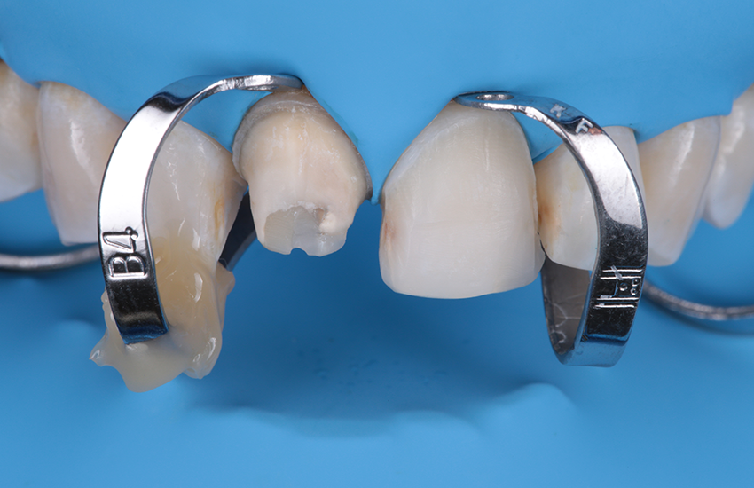 Solventum-BeitragVeneers-17444 Preparatons with rubber dam-850x550
