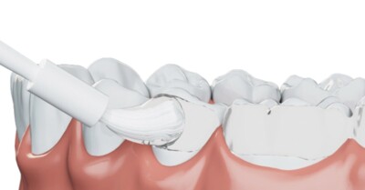 Entdecken Sie die Fluoridbehandlung der nächsten Generation!